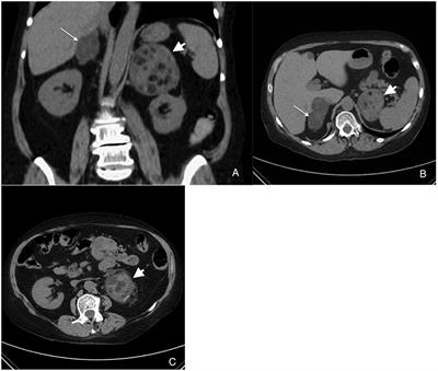 Coexistence of Myelolipoma and Primary Bilateral Macronodular Adrenal Hyperplasia With GIP-Dependent Cushing's Syndrome